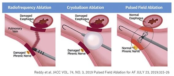 パルスフィールドの特長